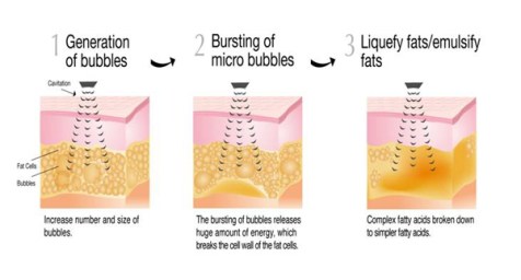 Fat Cavitation